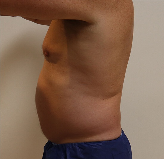 Liposuction before and after - before