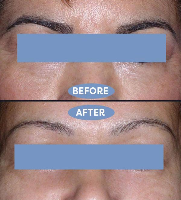 Blepharoplasty before and after - after
