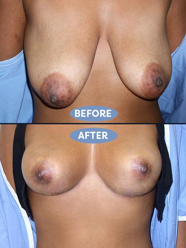 Breast Reduction before and after - after