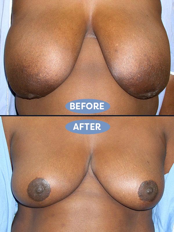 Breast Reduction before and after - after