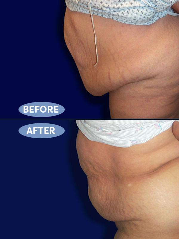 Abdominoplasty before and after - after