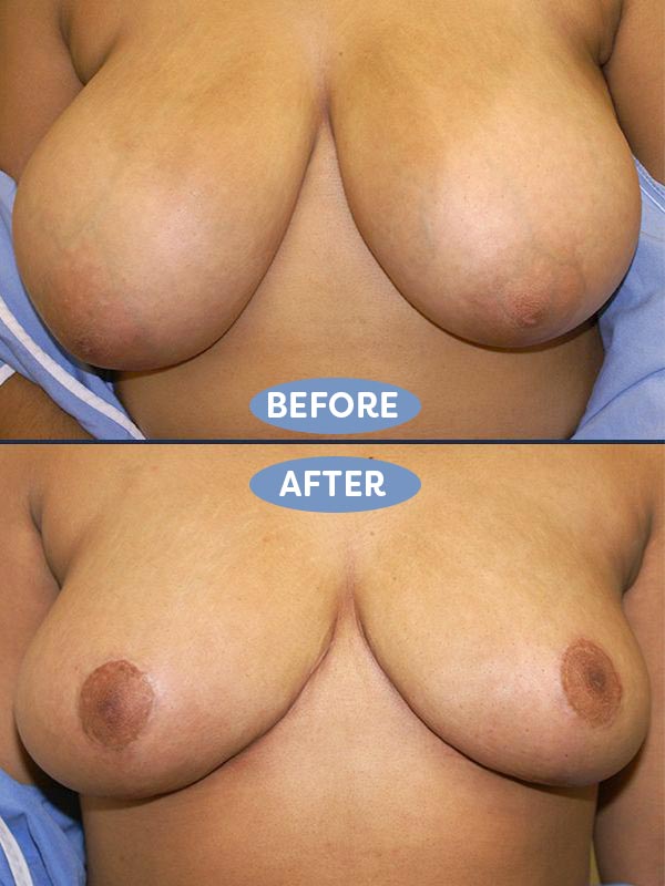 Breast Reduction before and after - before