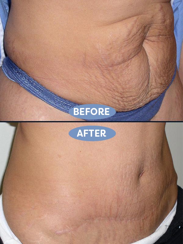 Abdominoplasty before and after - before