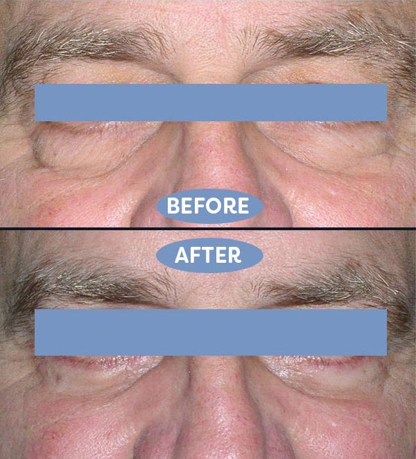 Blepharoplasty before and after - before