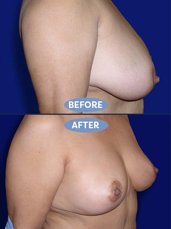 Breast Reduction before and after - before
