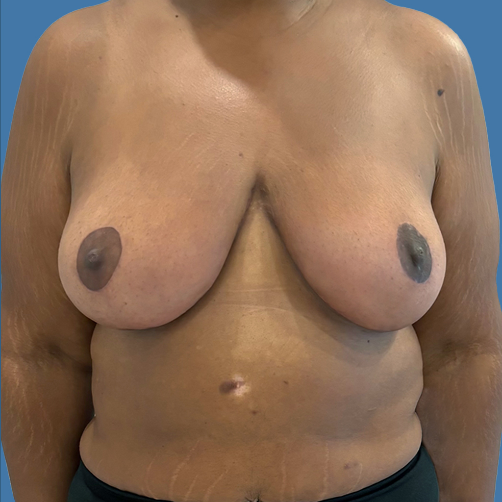 Breast Reduction before and after - after