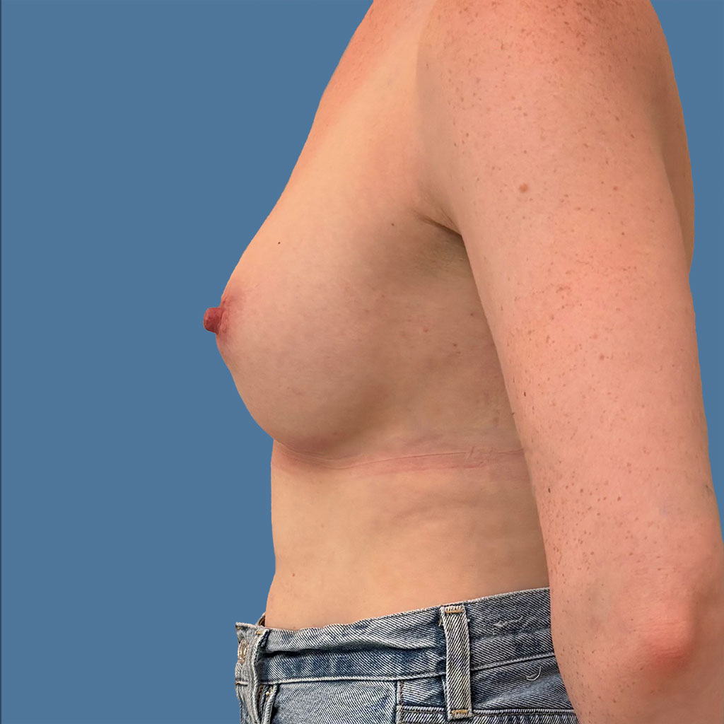 Breast Augmentation before and after - after