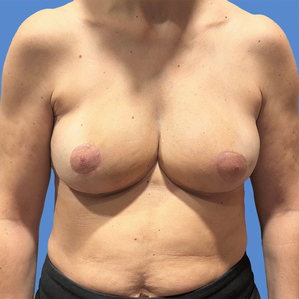 Breast Reduction before and after - after