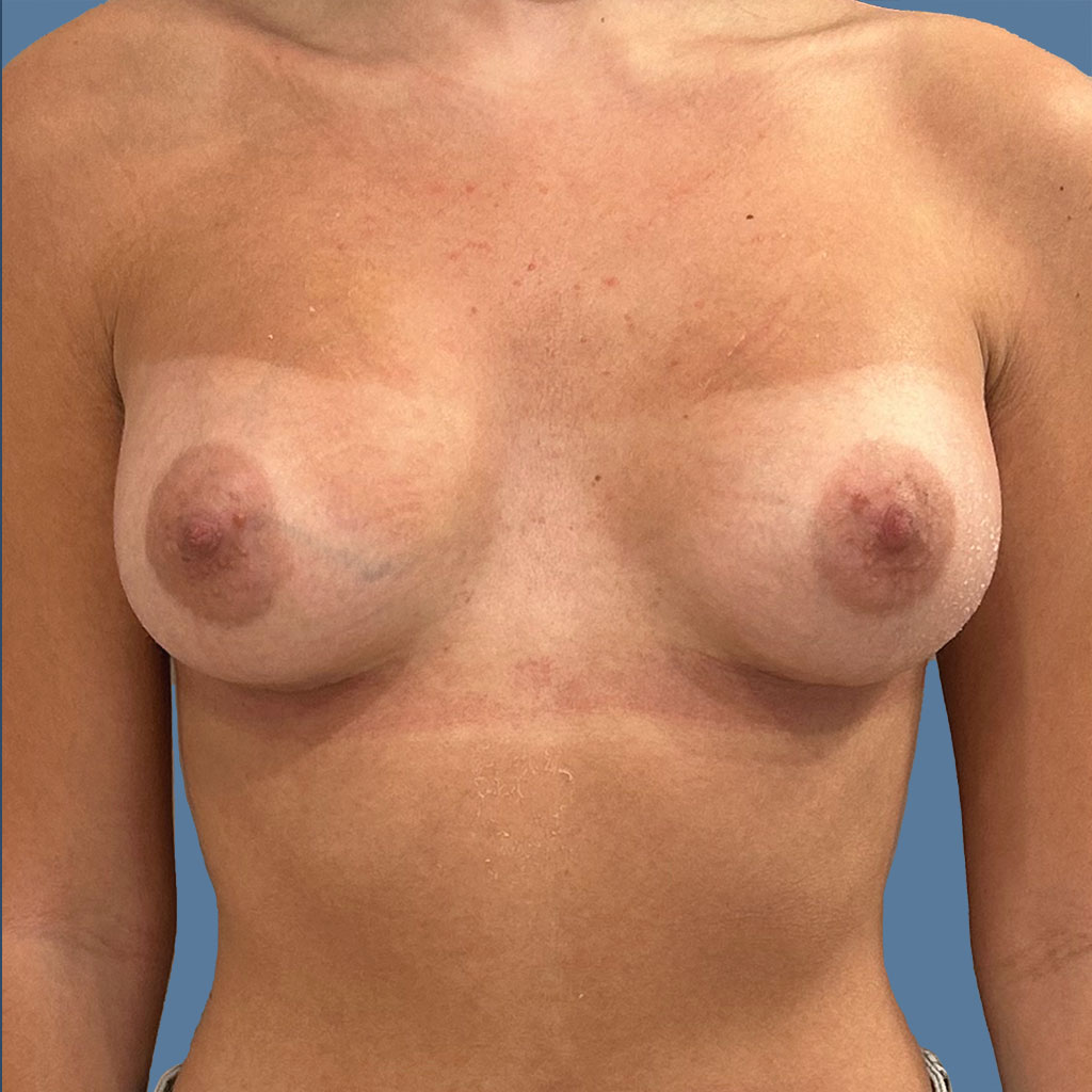 Breast Augmentation before and after - after