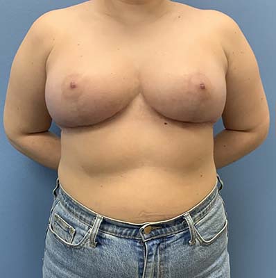 Breast Lift before and after - after