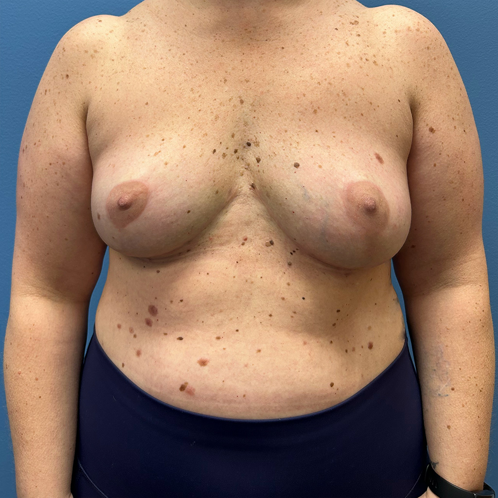 Breast Augmentation before and after - after