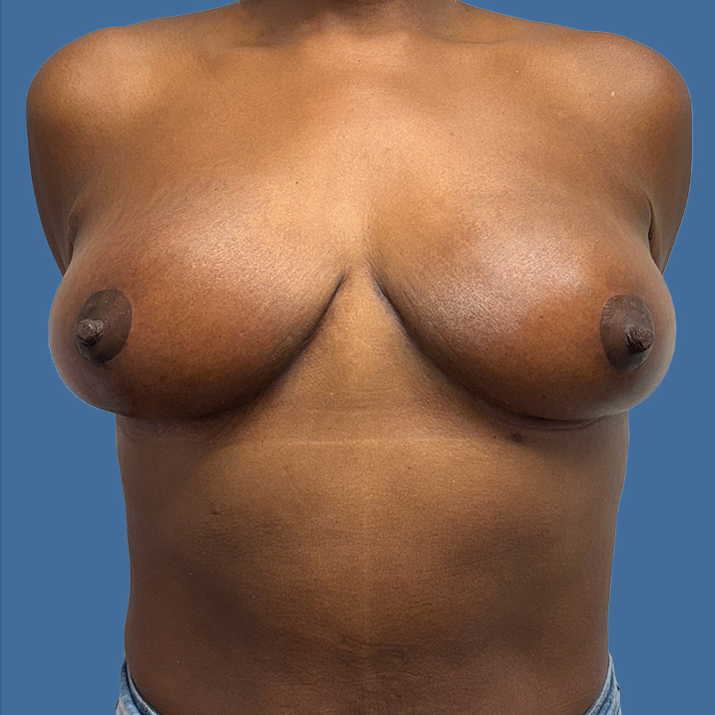 Breast Reduction before and after - after