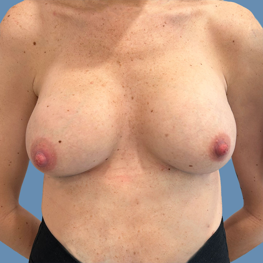 Breast Augmentation before and after - after