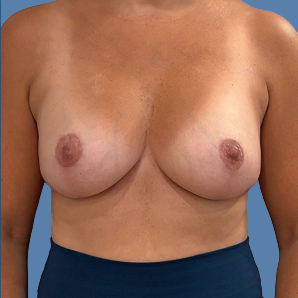 Breast Lift before and after - after