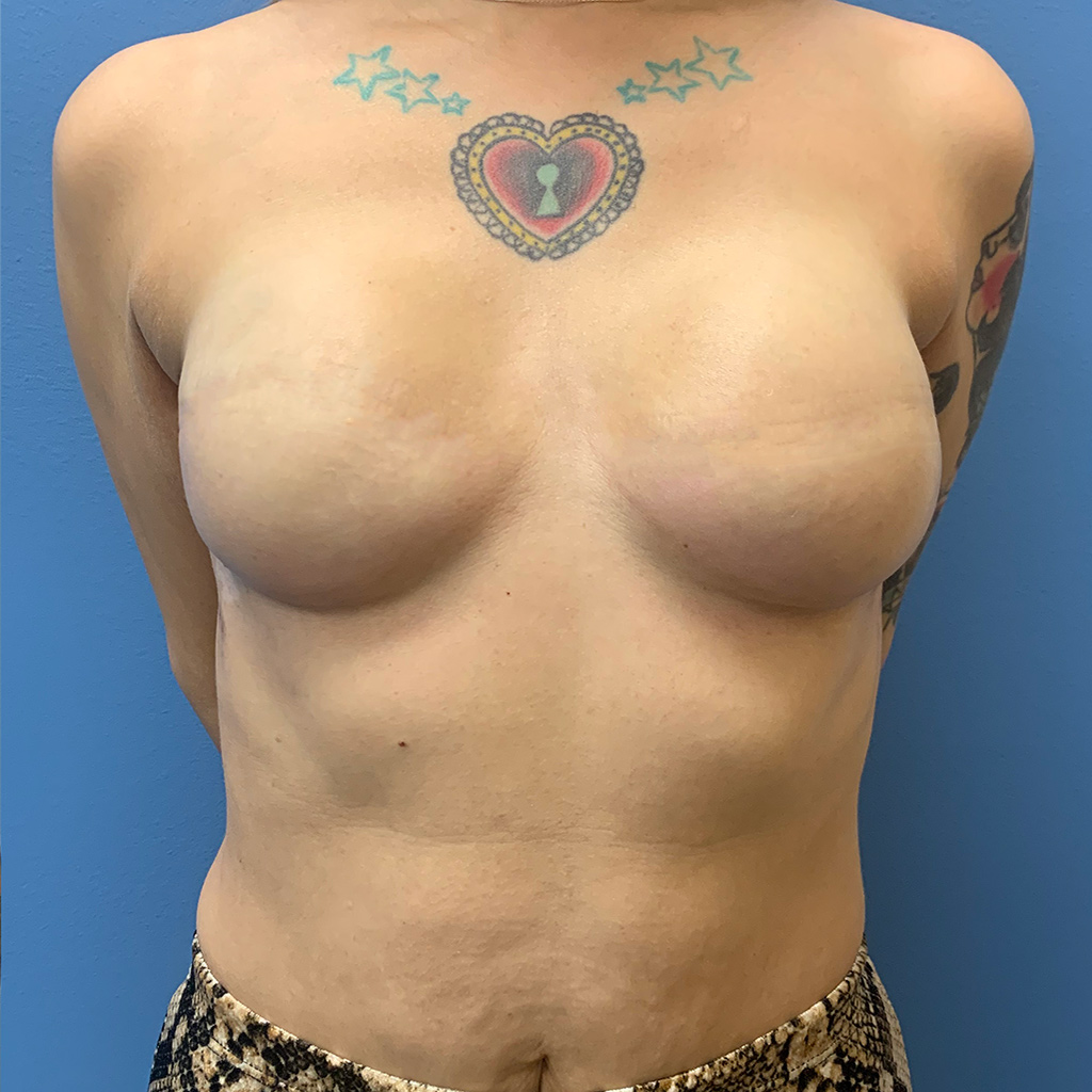 Procedure before and after - after