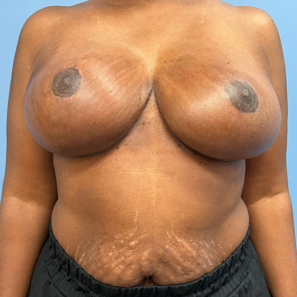Breast Reduction before and after - after