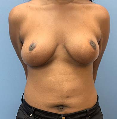 Breast Lift before and after - after