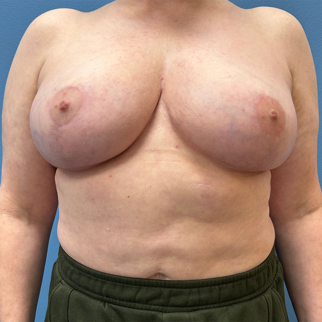 Breast Augmentation before and after - after