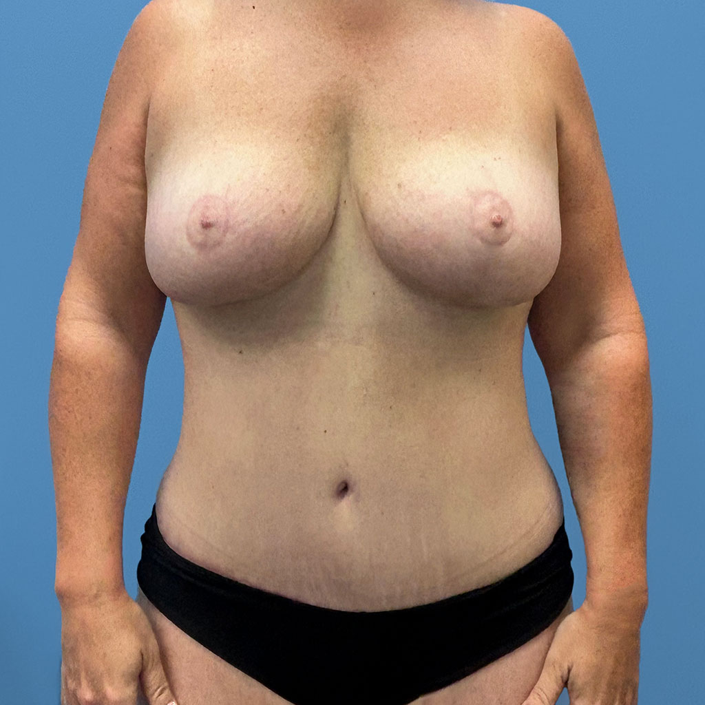 Mommy Makeover before and after - after