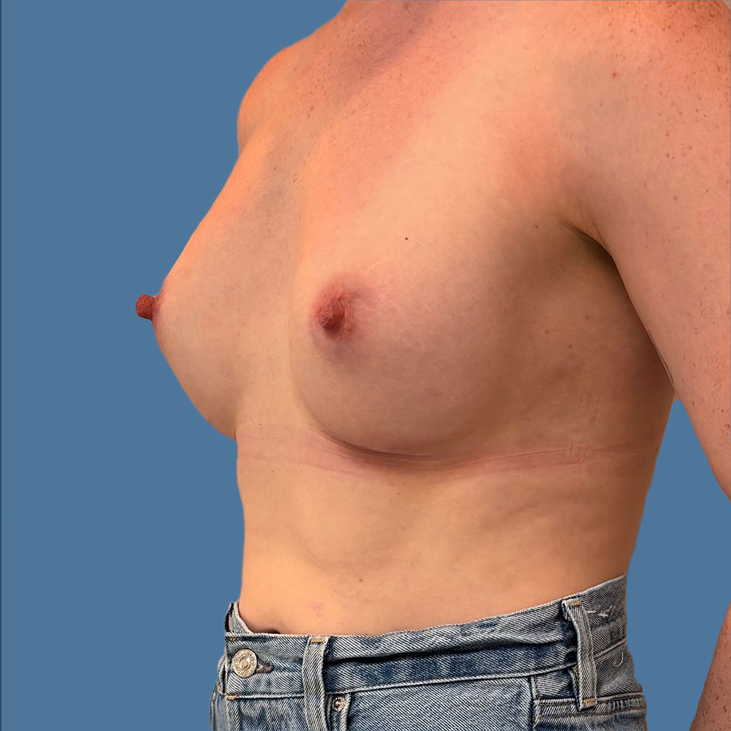 Breast Augmentation before and after - after