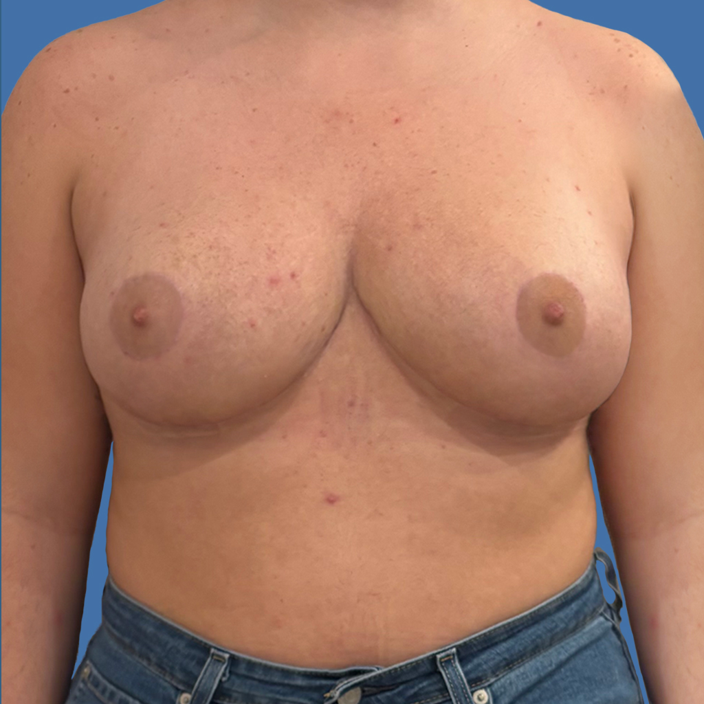 Breast Reduction before and after - after