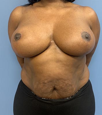 Breast Reduction before and after - after