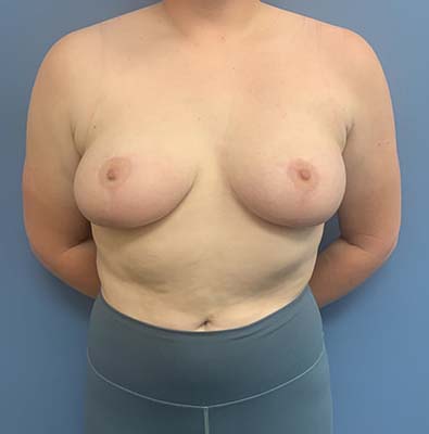 Breast Lift before and after - after