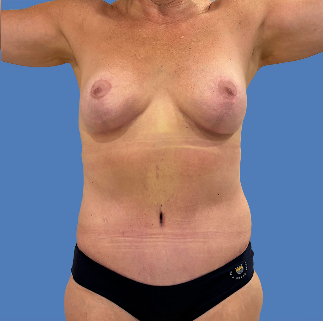 Mommy Makeover before and after - after