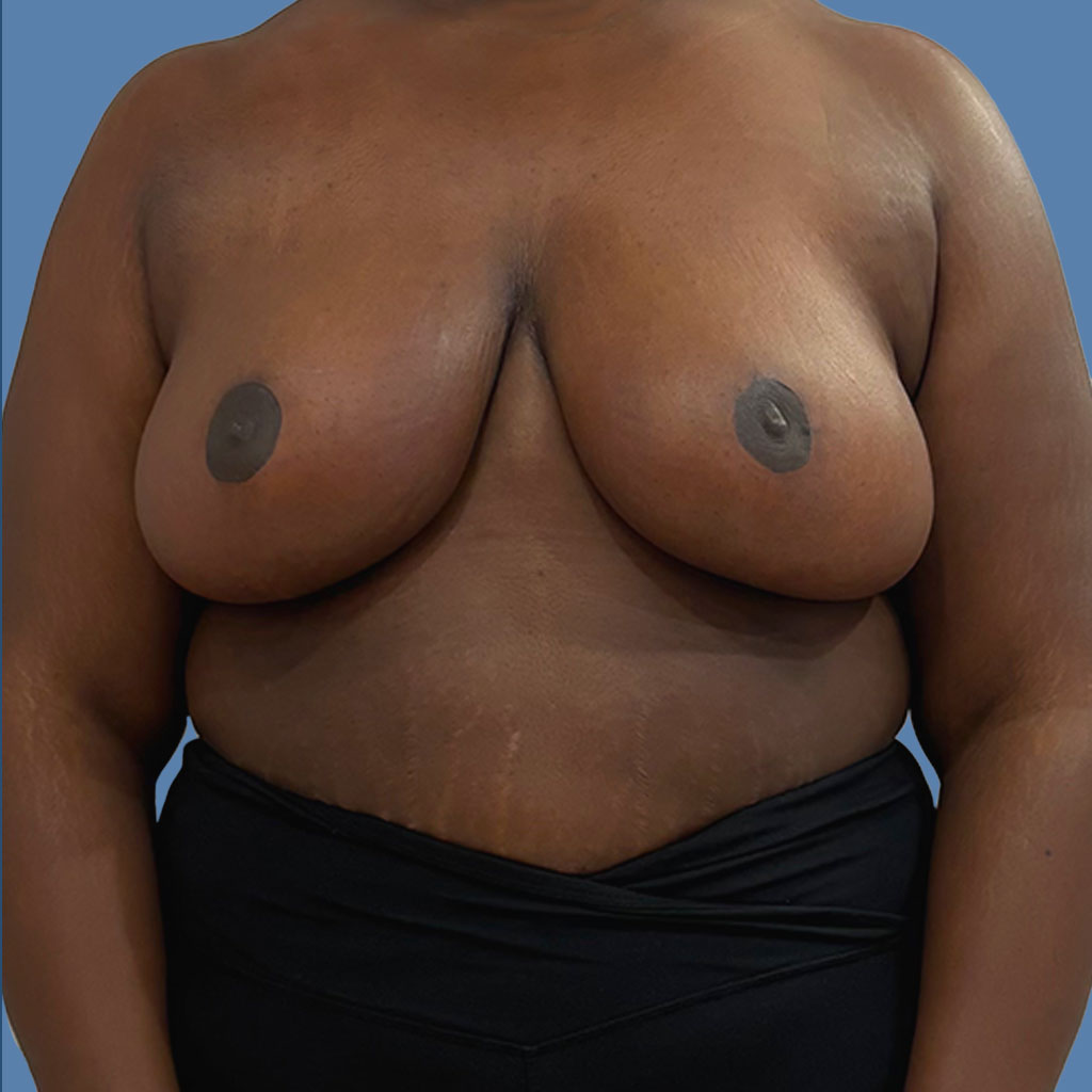 Breast Reduction before and after - after