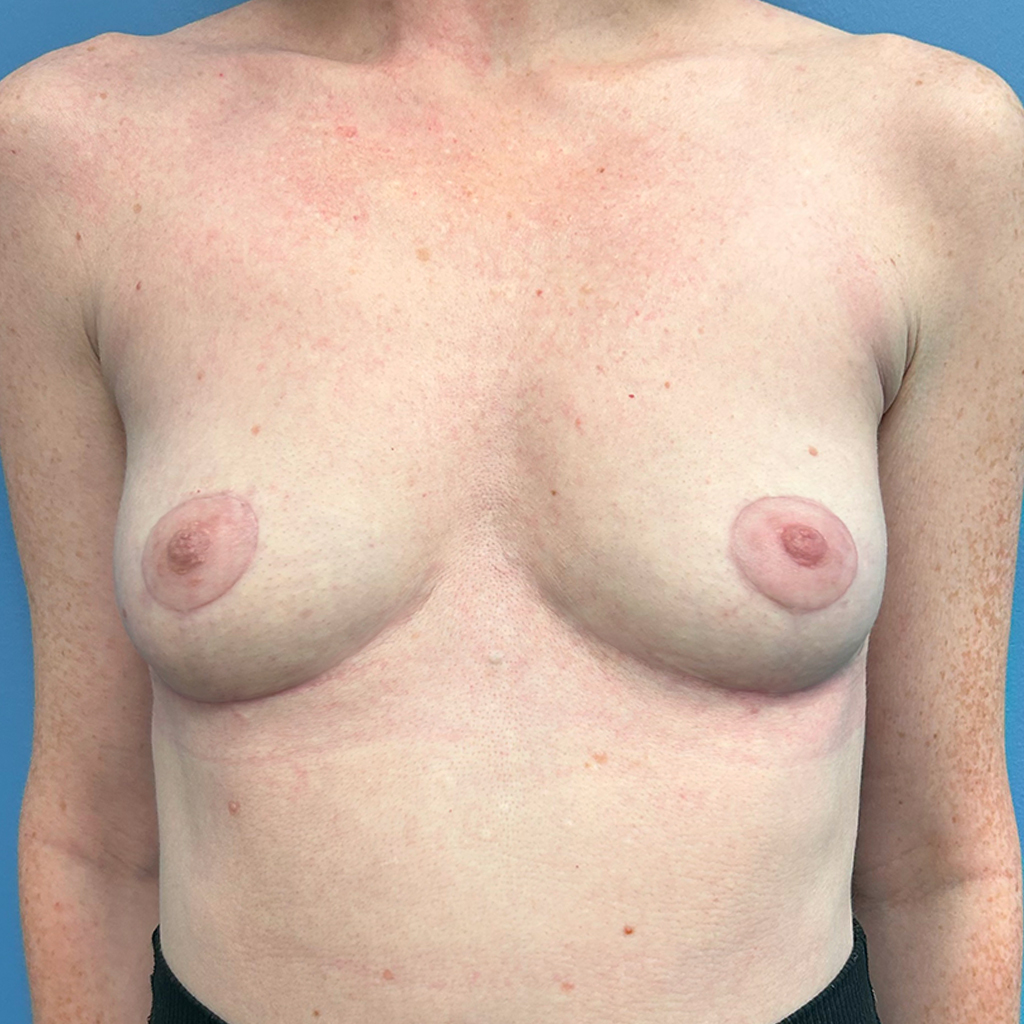 Breast Augmentation before and after - after