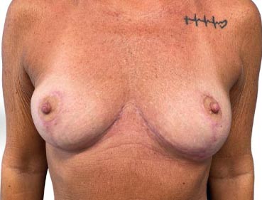 Breast Lift before and after - after