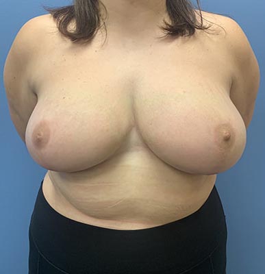 Breast Reduction before and after - after