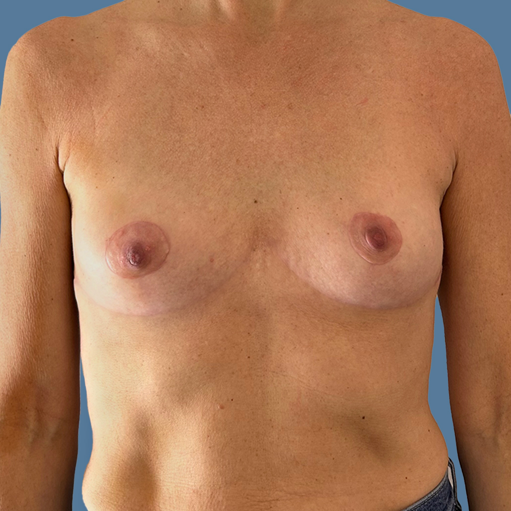 Breast Augmentation before and after - after