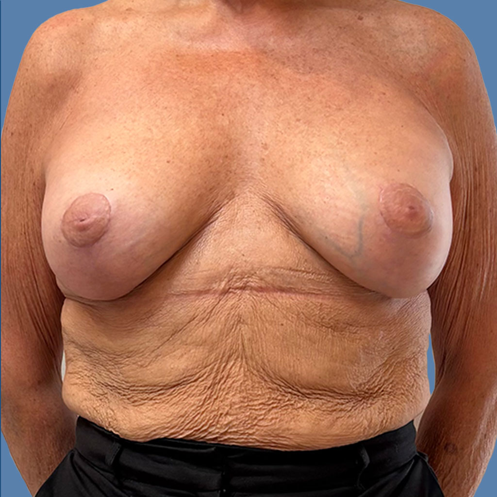 Breast Lift before and after - after
