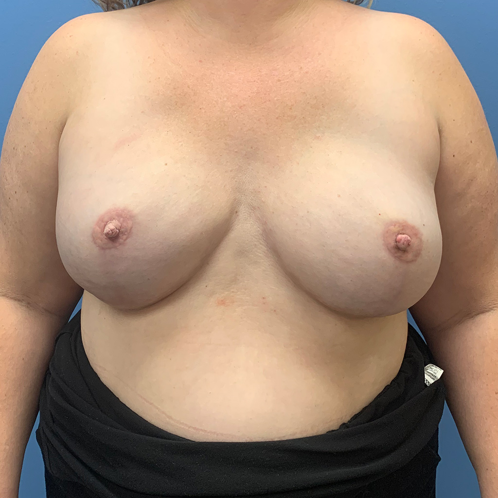 Procedure before and after - after
