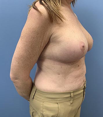 Breast Lift before and after - after