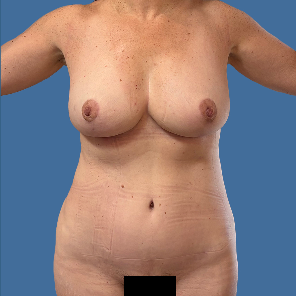 Mommy Makeover before and after - after