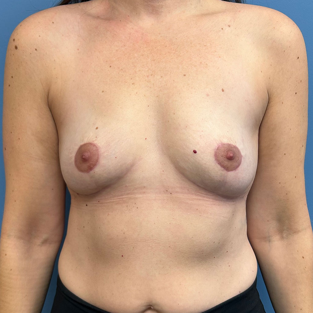 Breast Augmentation before and after - after