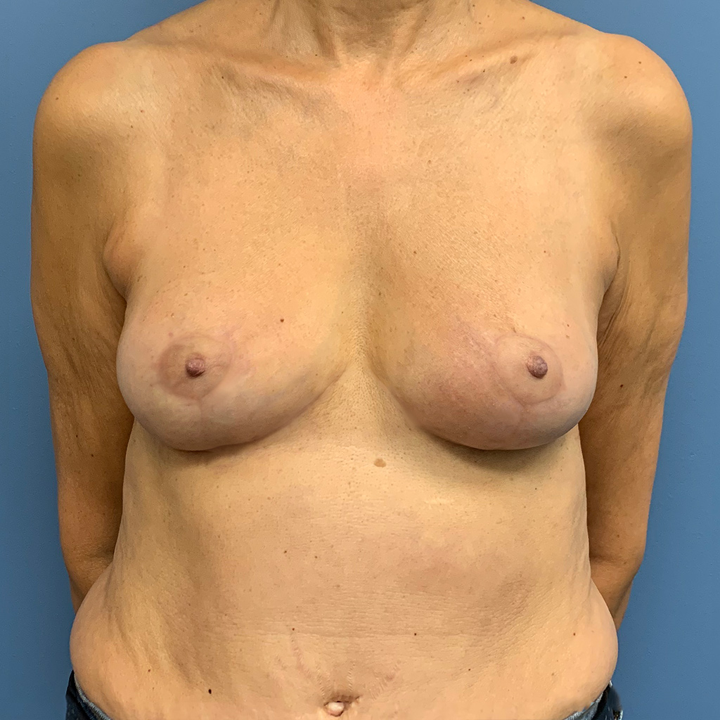 Breast Augmentation before and after - after
