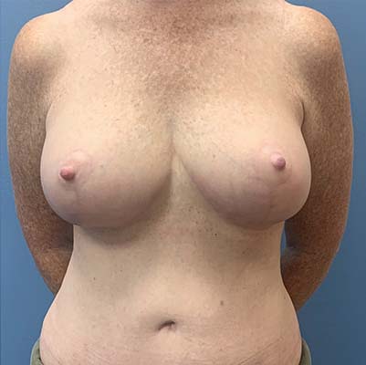 Breast Lift before and after - after