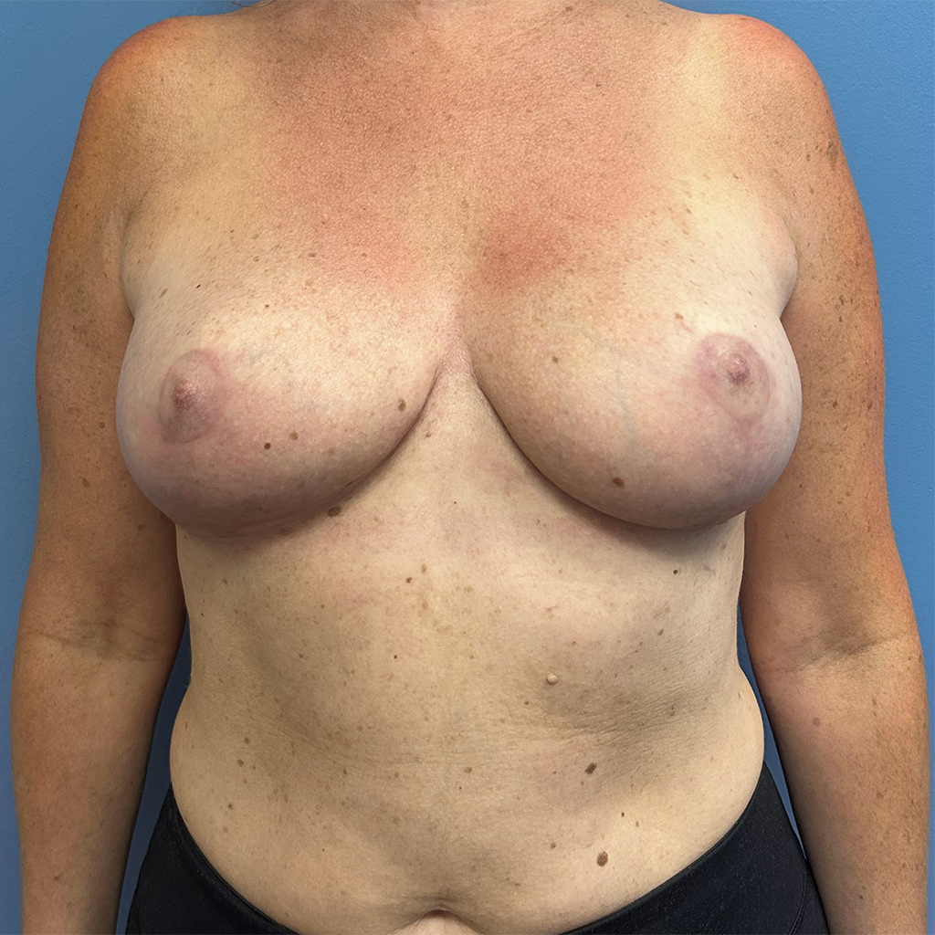 Breast Reduction before and after - after