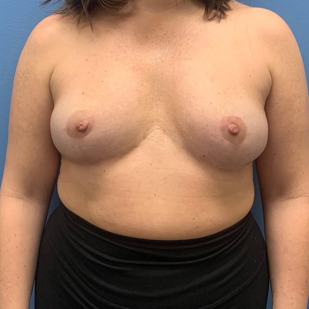 Breast Augmentation before and after - after