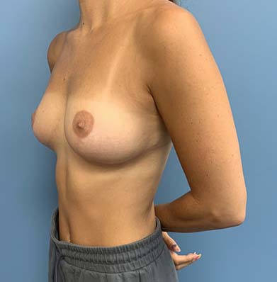 Breast Lift before and after - after