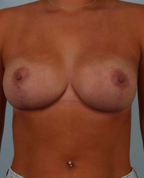 Breast Lift before and after - after