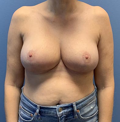 Breast Reduction before and after - after