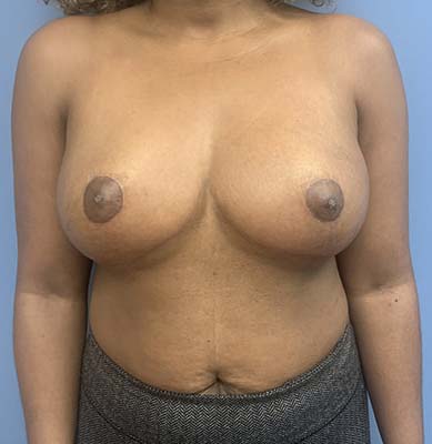 Breast Lift before and after - after