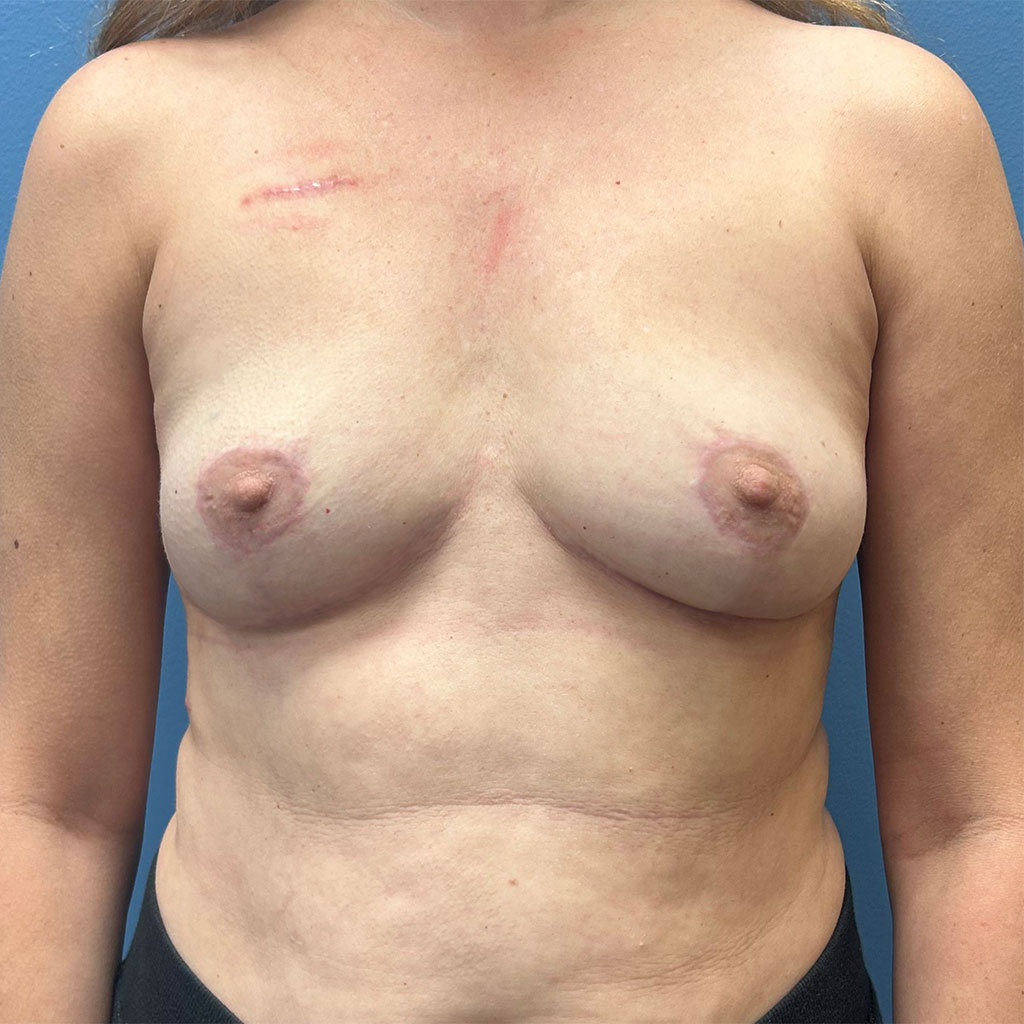 Breast Augmentation before and after - after
