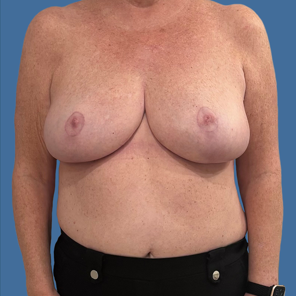 Breast Reduction before and after - after