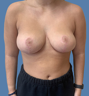 Breast Lift before and after - after