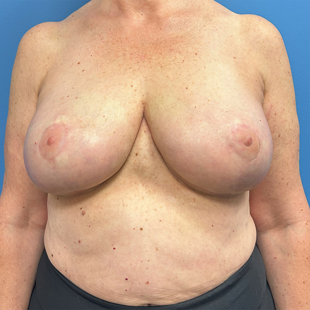 Breast Reduction before and after - after